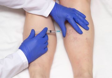 inyeccion en pierna durante tratamiento de esclerosis de varices
